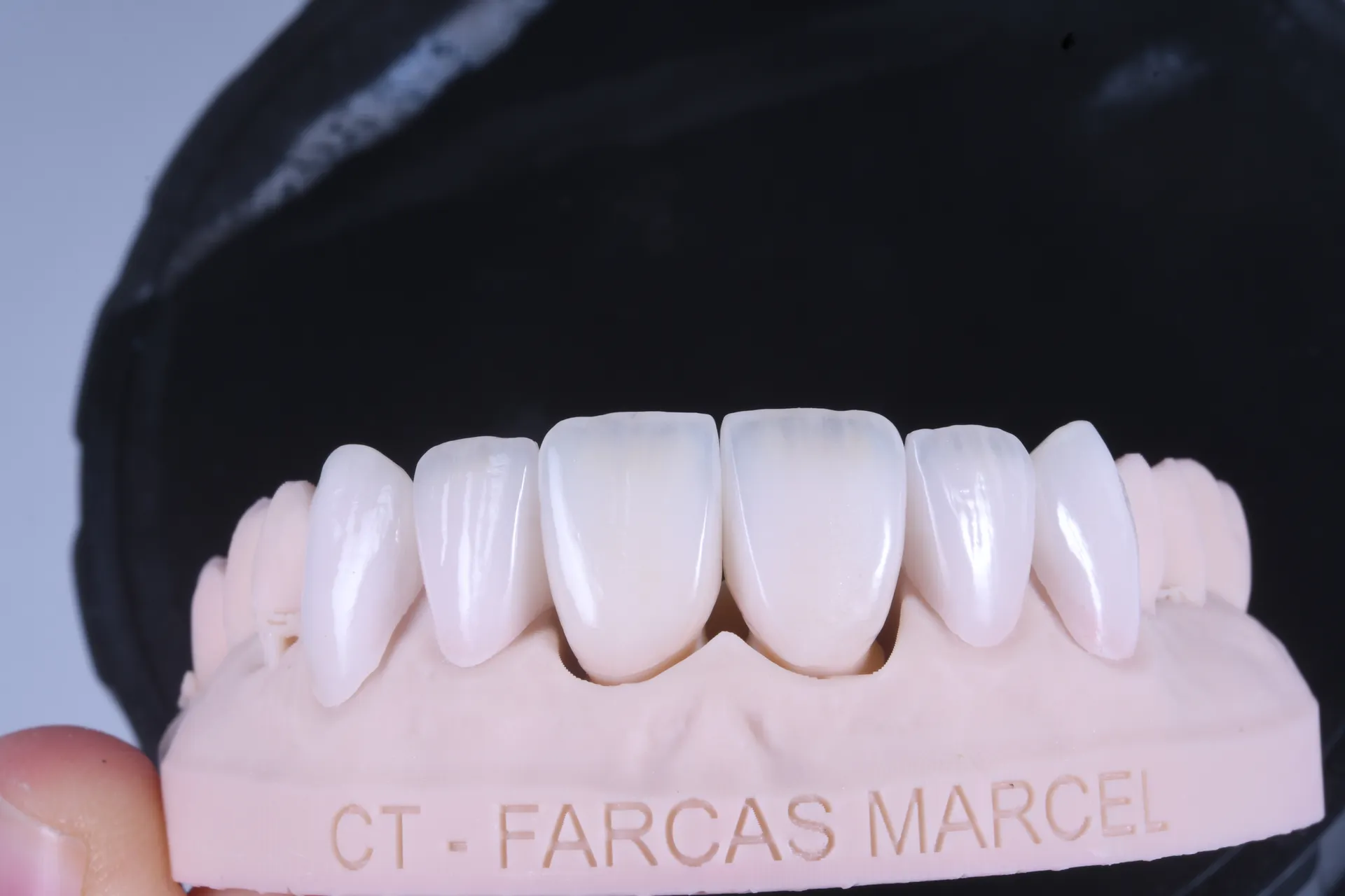 După: rezultatul final cu fațete ceramice - Marcel