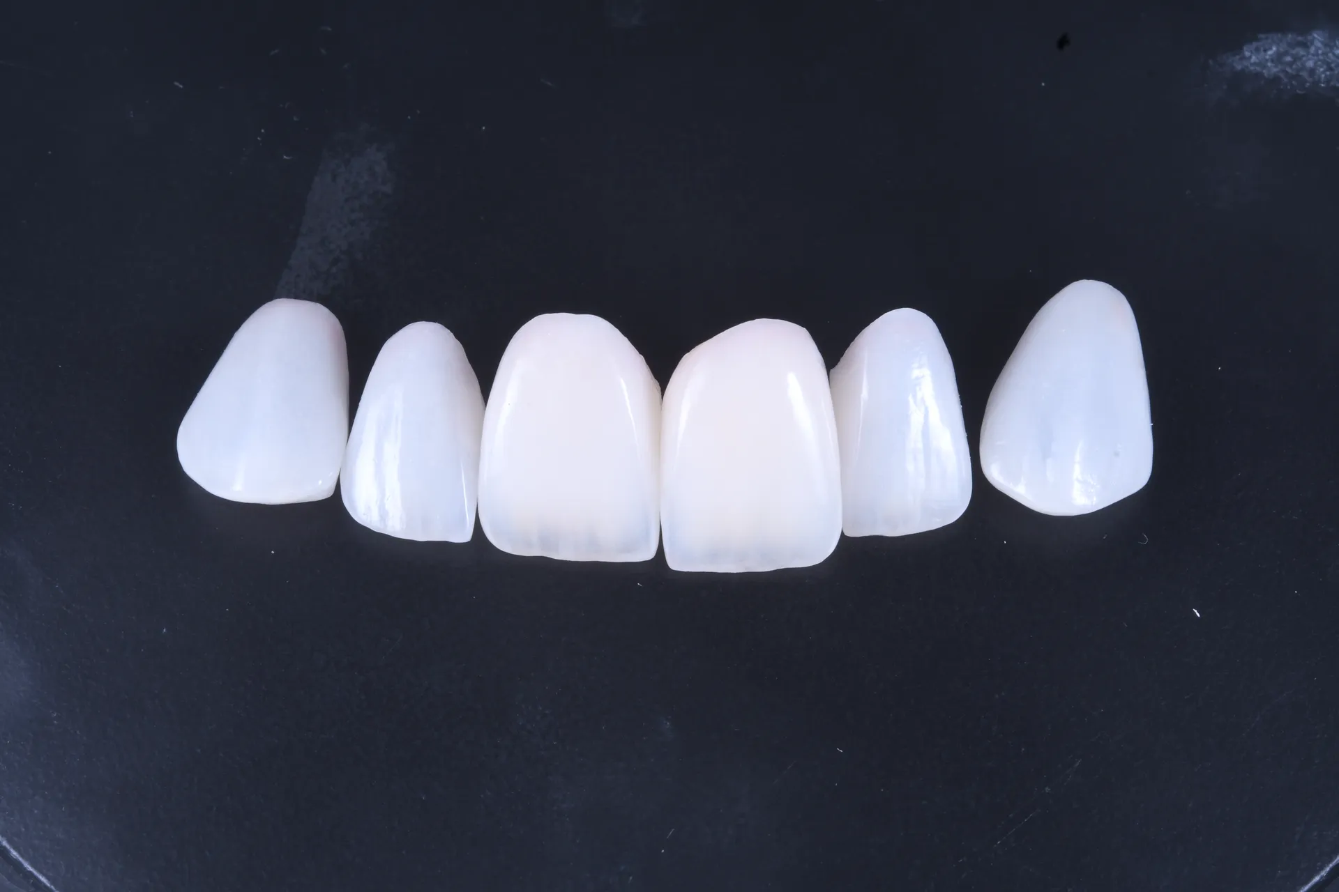 Caz Marcel: estetică dentară premium - rezultat final