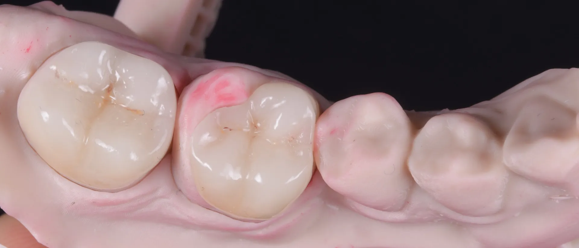 Tratament endodontic la dr.Tim Timișoara