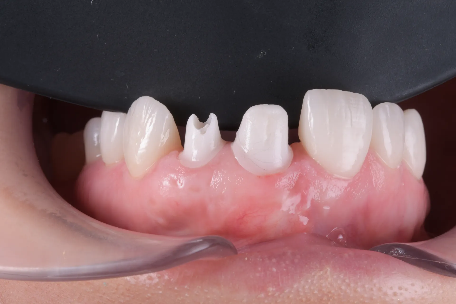 Implant dentar — procedură clinică