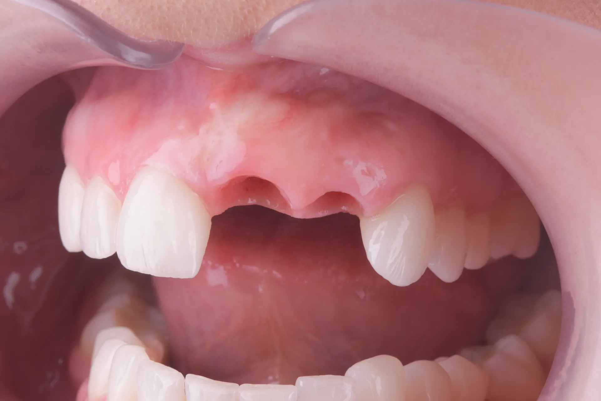Implant dentar — rezultat final