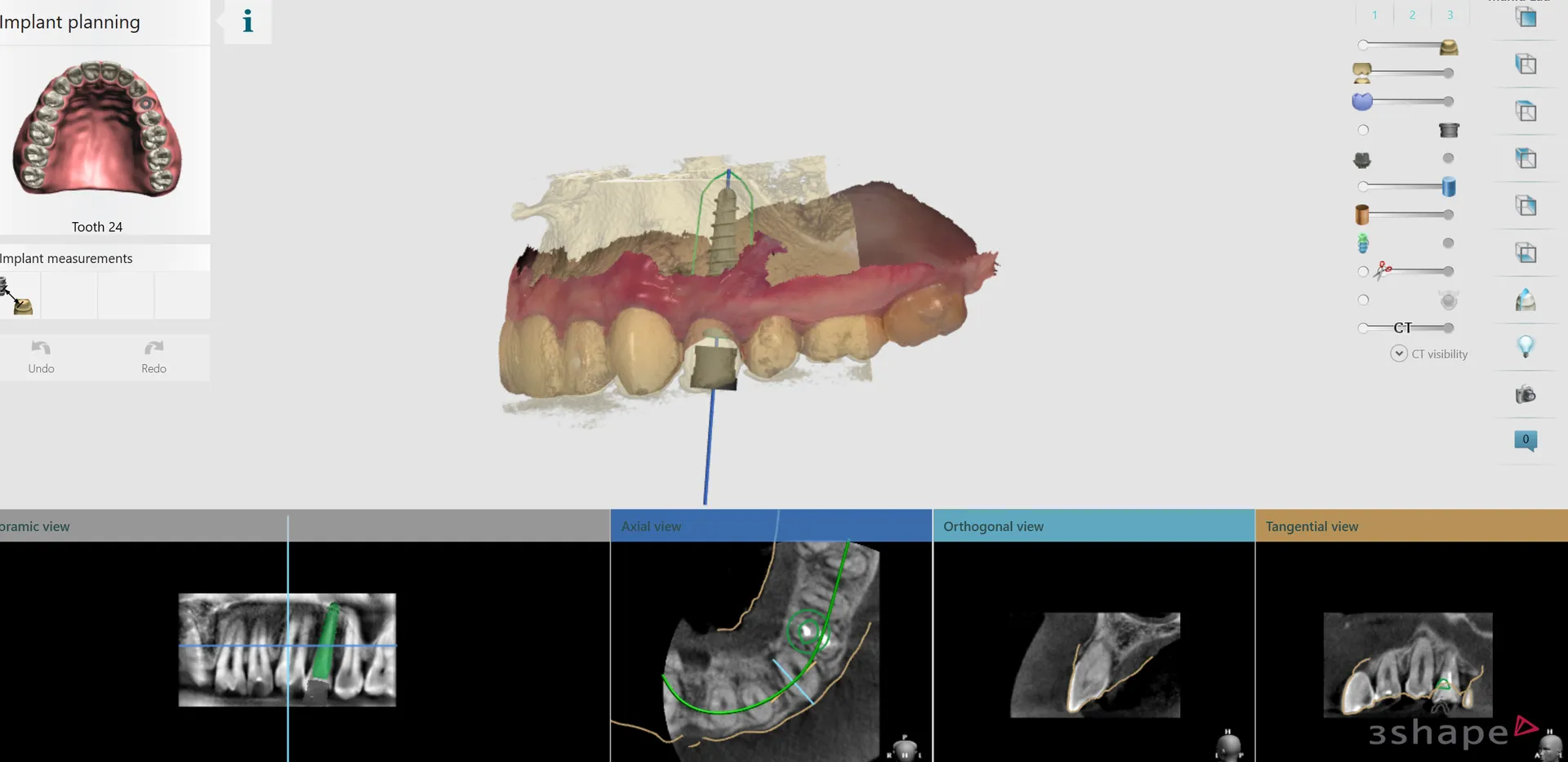 Planificare chirurgicală implant dentar
