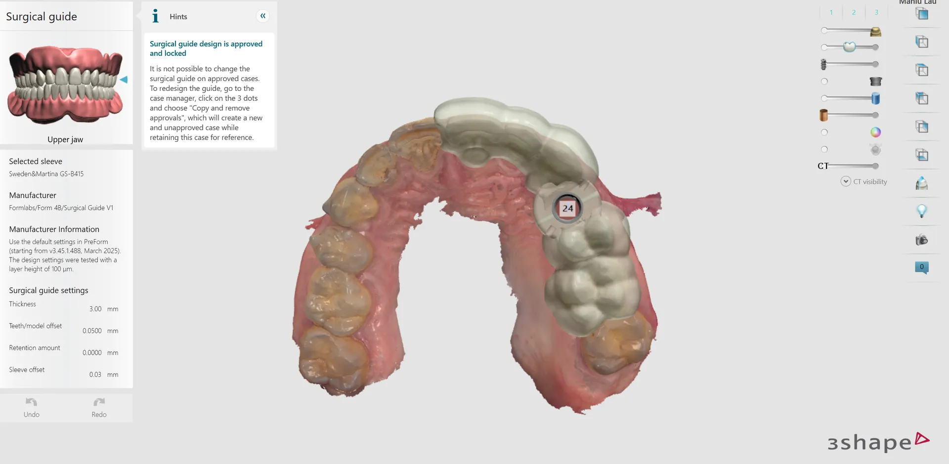 Ghid chirurgical digital implant