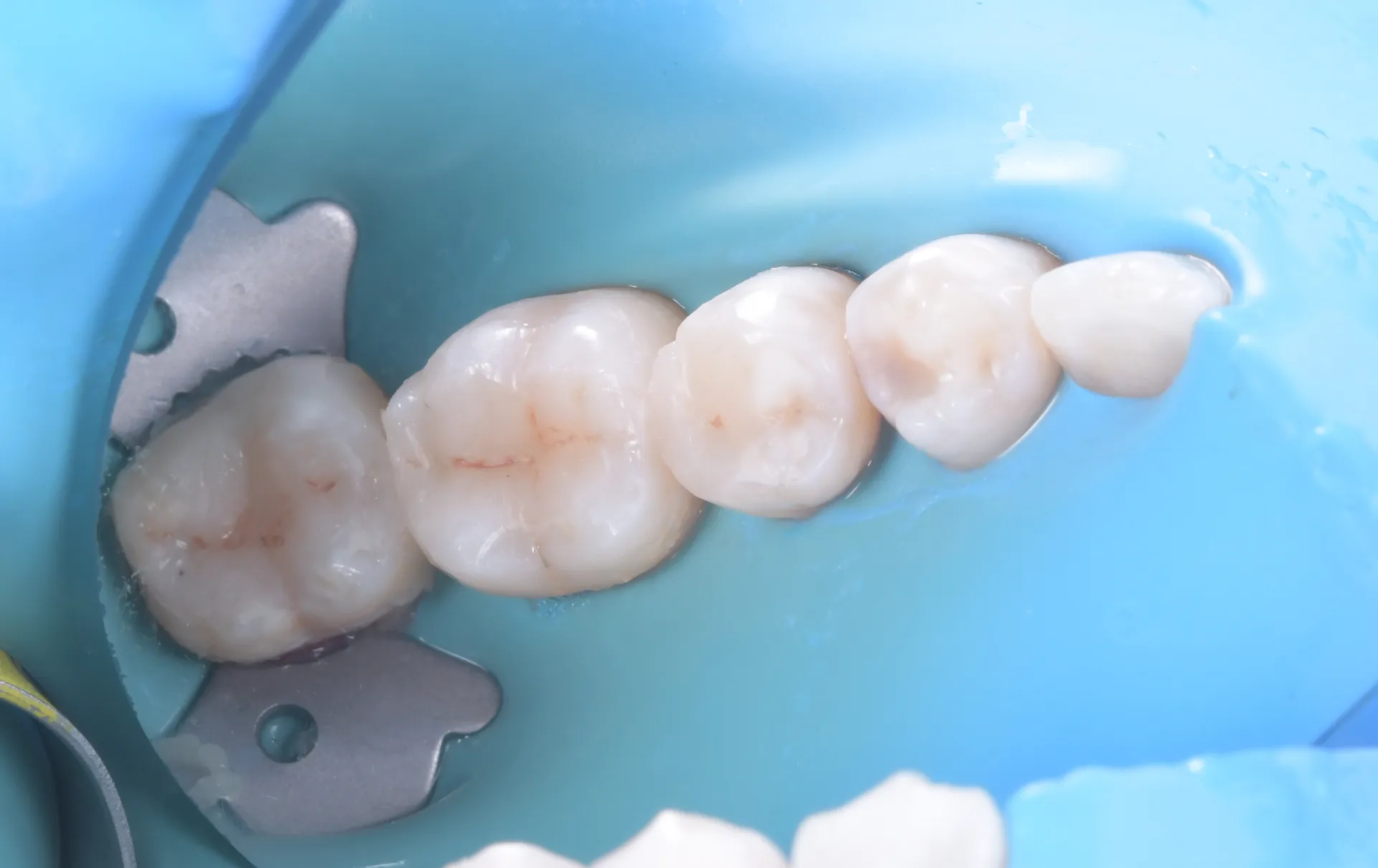 Odontoterapie — tratament conservativ și restaurări dentare la dr.Tim Timișoara