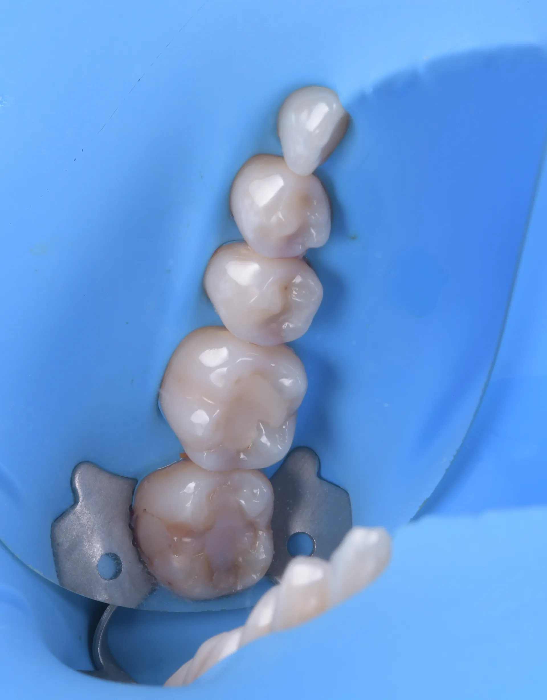Obturații dentare de precizie sub izolare — dr.Tim