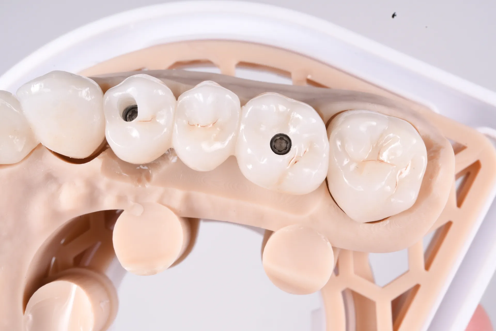 Caz Protetica pe Implant