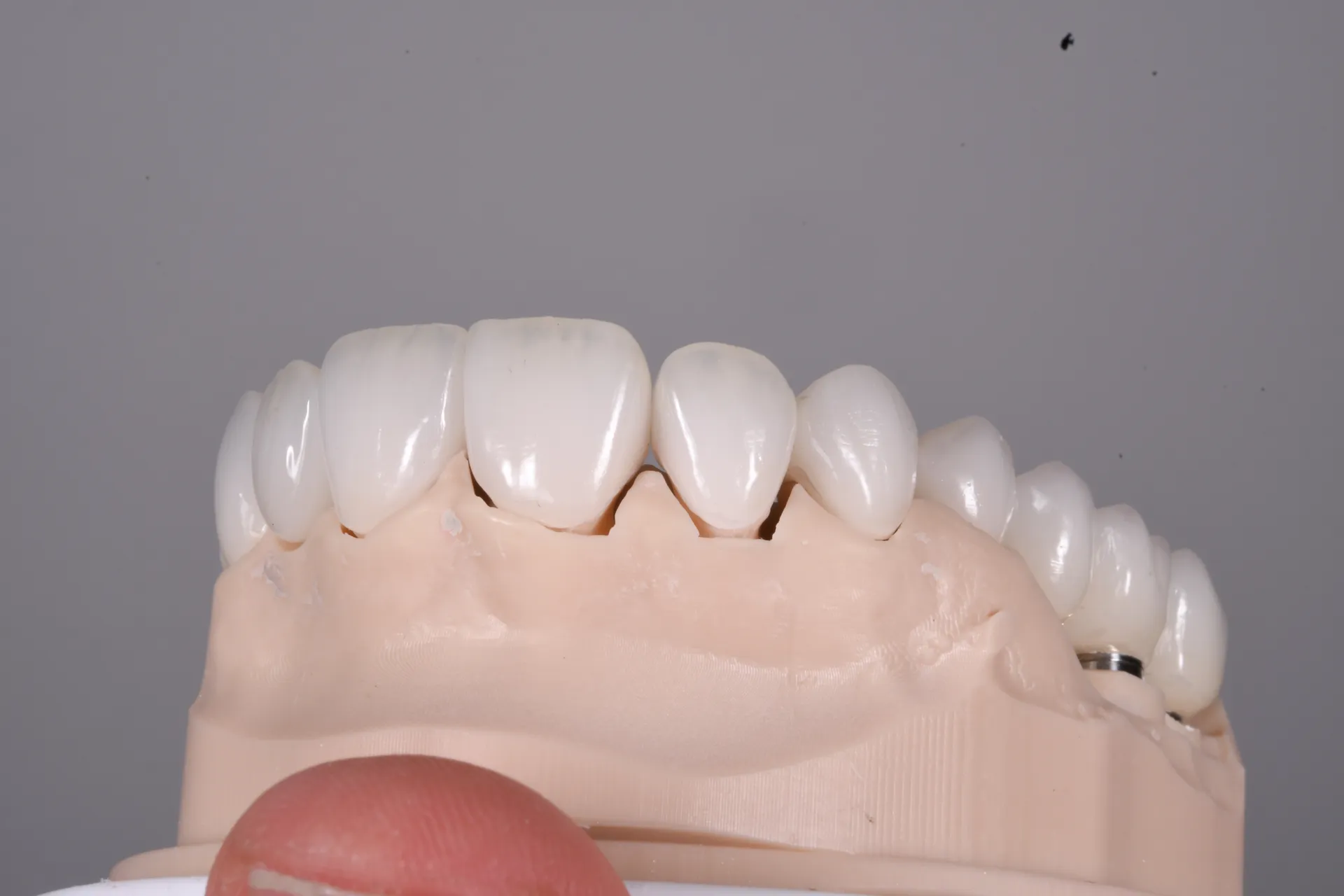 Coroane dentare - restaurare completă